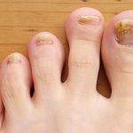 toe-fungus-resized-56a315a95f9b5