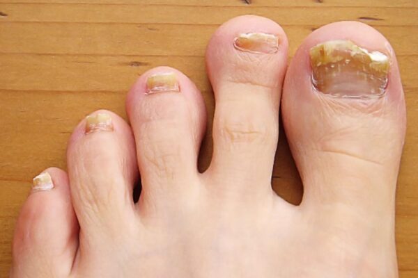 toe-fungus-resized-56a315a95f9b5