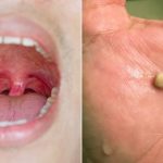 What-are-Tonsil-Stones-722x406