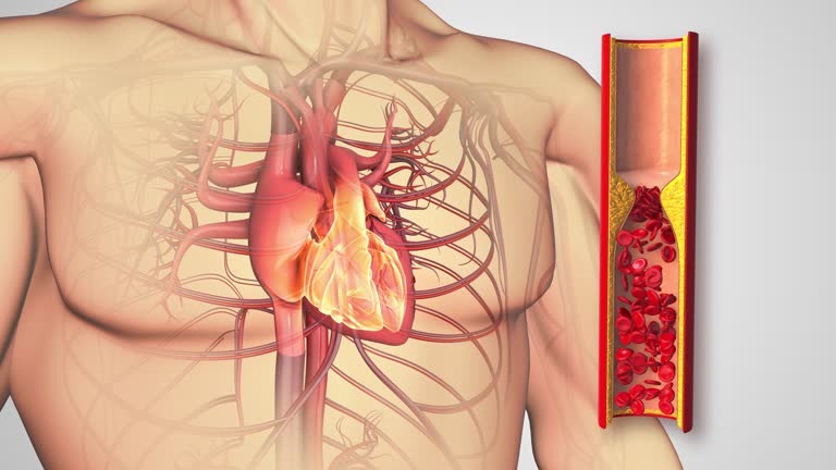 atherosclerosis-disease-or-human