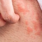 1-Rashes-in-Groin-Area_-Causes-S