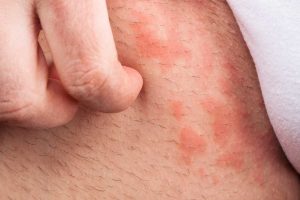 1-Rashes-in-Groin-Area_-Causes-S