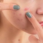 acne-statistics-uk