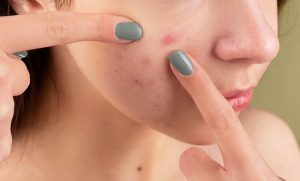 acne-statistics-uk