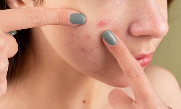 acne-statistics-uk